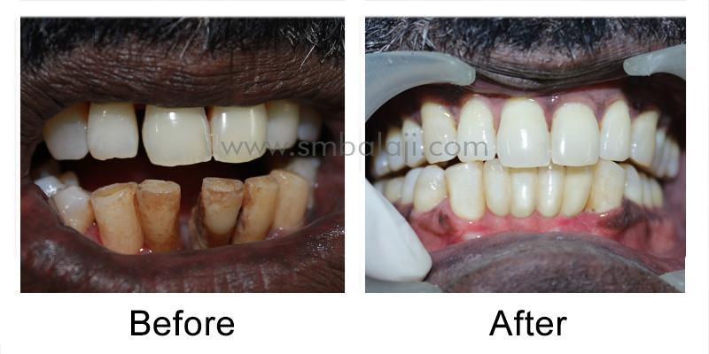 Immediate Dental Implants India