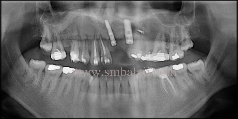 Post Operative Opg Showing Osseointegrated Dental Implants With The Jaw Bone