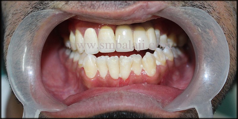 Fixed Ceramic Prosthesis for Unilateral Cleft Patient with Autogenous Graft 9 Fixed Ceramic Prosthesis Loaded Onto The Implant For Enhanced Appearance