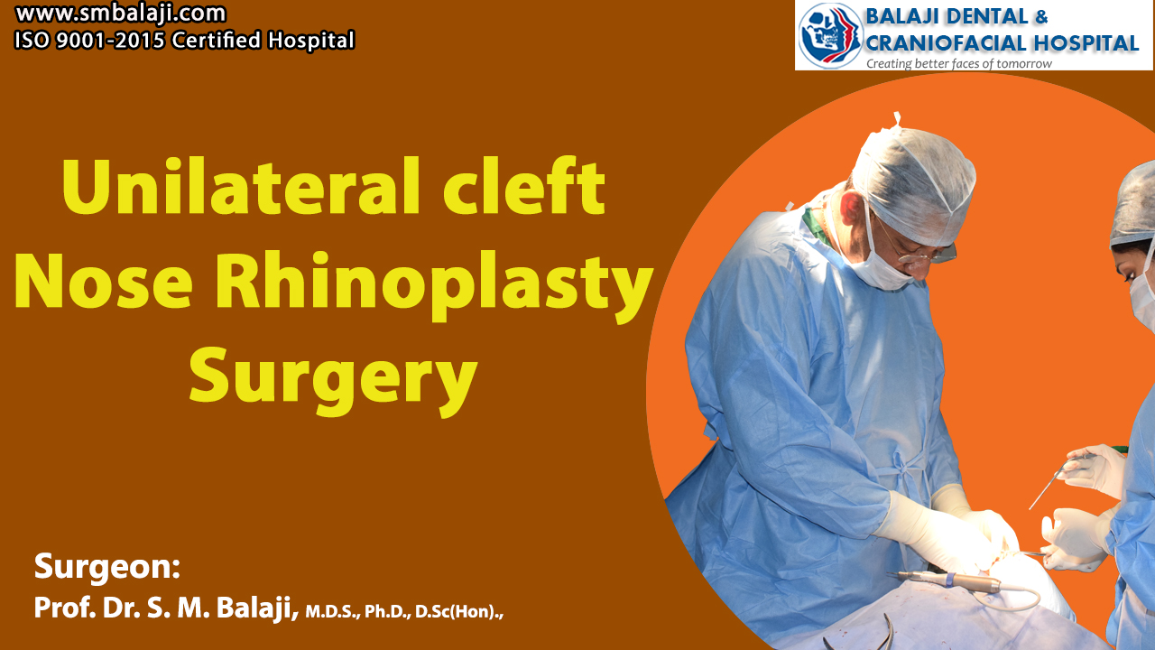Unilateral Cleft Nose Rhinoplasty Surgery