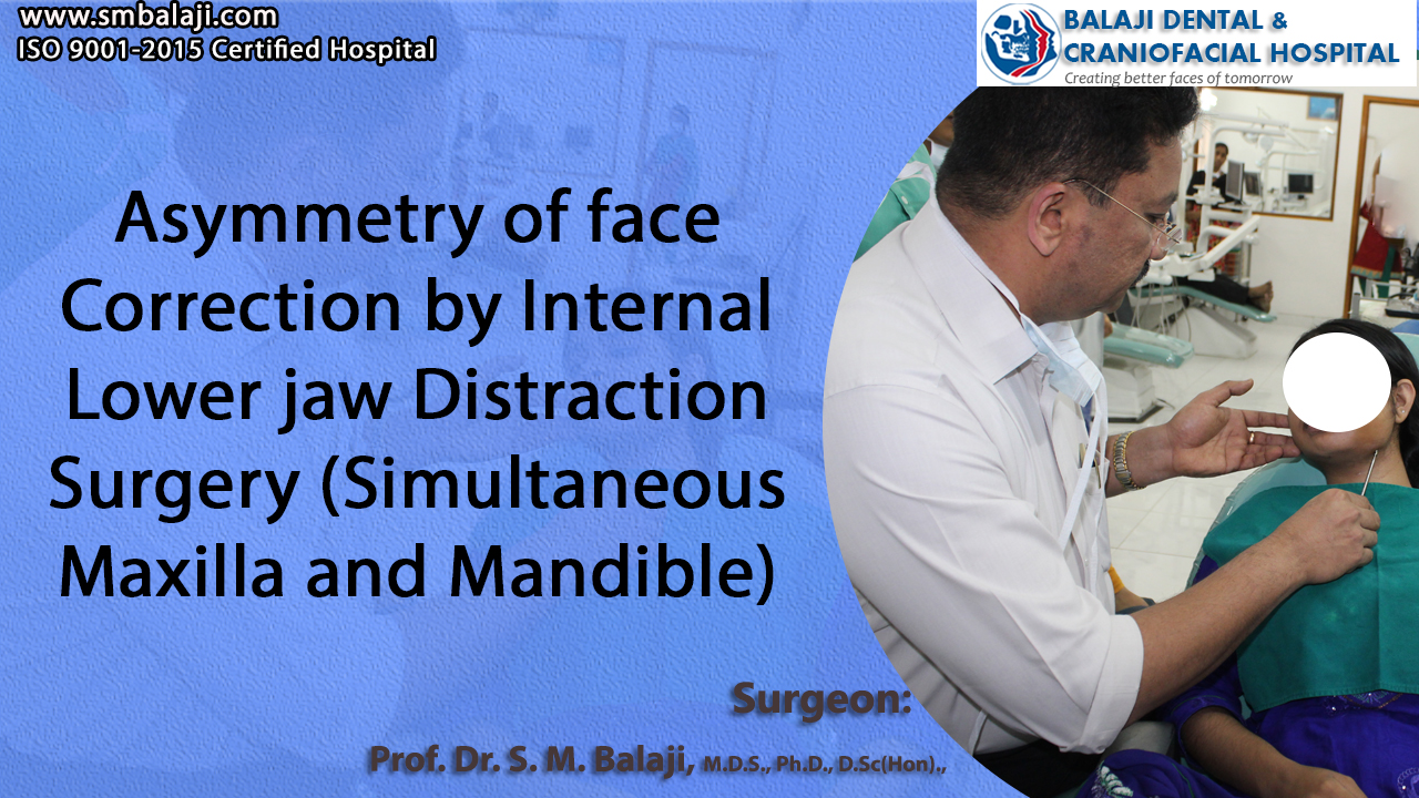 Asymmetry of face Correction by Internal Lower jaw Distraction Surgery