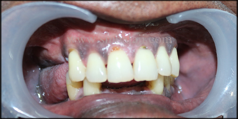 Insecure Patient With Missing Upper And Lower Teeth
