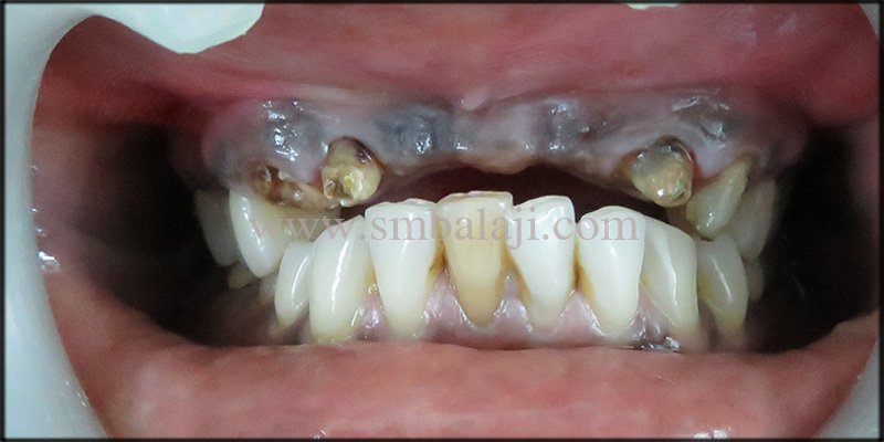 Immediate Dental Implants for Smile Rehab 1 Patient With Missing Upper Central Incisors