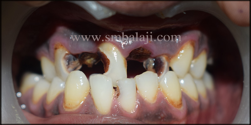 Patient With Severely Decayed And Broken Teeth