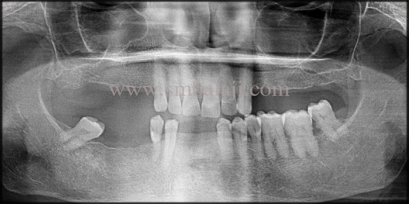 Pre- Operative X-Ray Shows Lack Of Teeth In Upper And Lower Jaw, With Sufficient Bone Height Of The Relative Site
