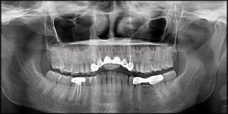 Immediate Dental Implants for Smile Rehab 2 Pre-Operative Opg Showing Missing Upper Central Incisors And Incomplete Root Canal Treated Teeth On Either Side Of The Dental Bridge