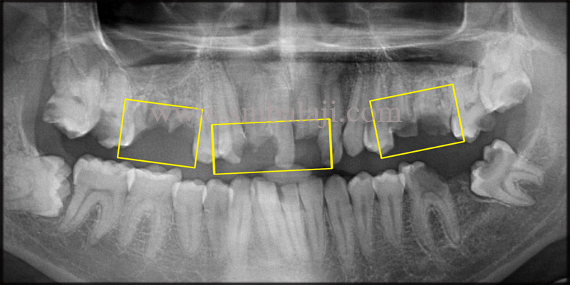Dental Implants for Grossly Decayed Teeth 2 Pre-Operative Opg Shows Root Stumps And Broken Teeth In The Upper Anteriors And Posteriors