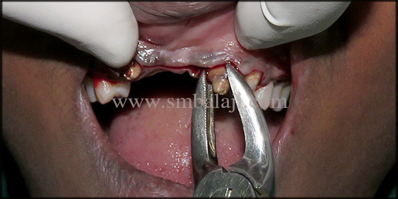 Extraction Of Failed Root Canal Treated Teeth Done Under Local Anesthesia