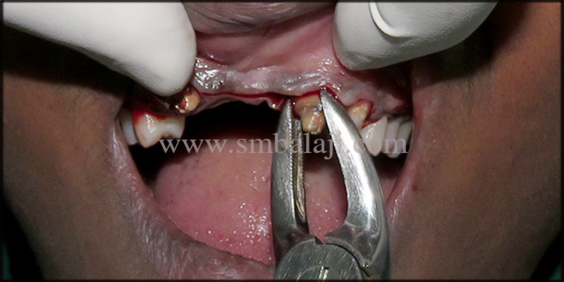 Immediate Dental Implants for Smile Rehab 3 Extraction Of Failed Root Canal Treated Teeth Done Under Local Anesthesia