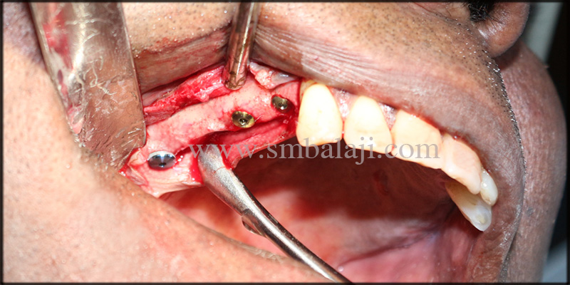 Gum Tissue Elevated And Dental Implants Placed In The Upper Right Posterior Bone