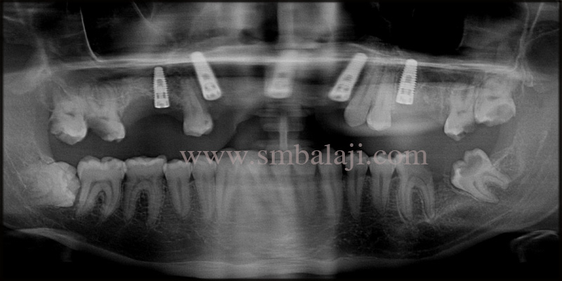 Dental Implants for Grossly Decayed Teeth 3 Post- Operative Opg Shows Well Osseointegrated Dental Implants