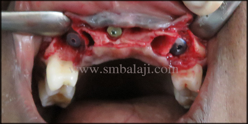 Immediate Dental Implants for Smile Rehab 4 Dental Implants Placed At The Relative Site