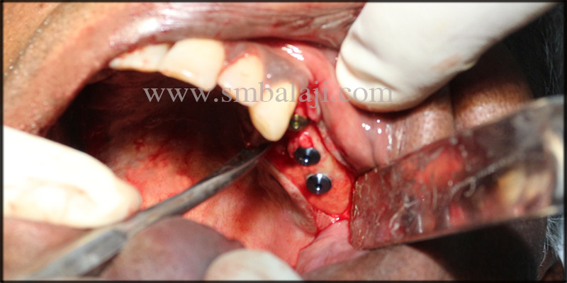 Dental Implants Placed In Upper Left Posterior Region