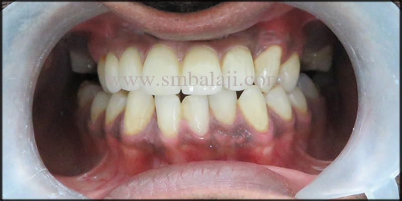 Dental Implants for Grossly Decayed Teeth 4 The Makeover With A Natural Looking Fixed Ceramic Prosthesis