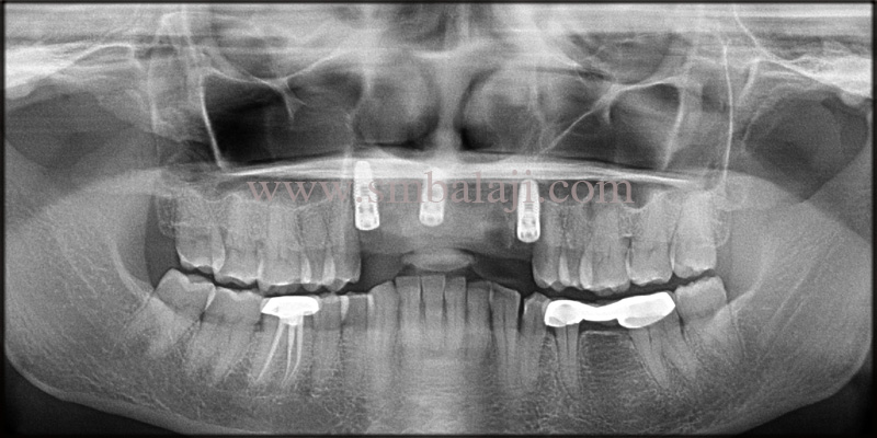 Immediate Dental Implants for Smile Rehab 5 Post-Operative Opg Showing Well Integrated Dental Implants In The Upper Jaw Bone