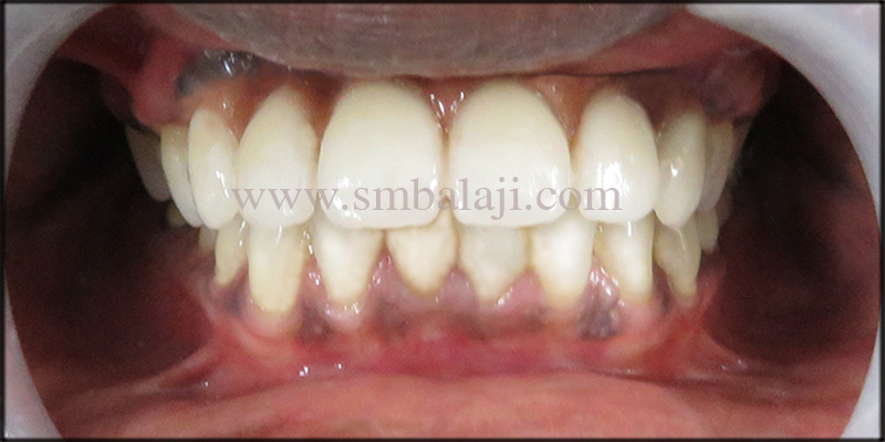 Immediate Dental Implants for Smile Rehab 6 Happy Patient With Natural Looking Fixed Ceramic Prosthesis