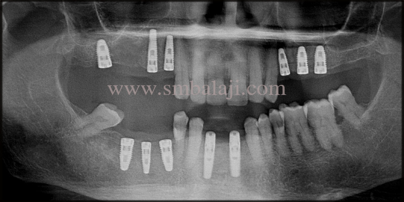 Post-Operative X-Ray Shows Well Integrated Implants With The Jaw Bone