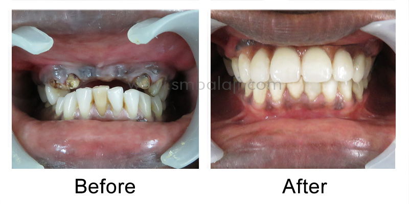 Immediate Dental Implants for Smile Rehab