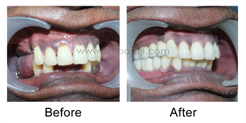 Dental Implant and Ceramic Prosthesis Patient before and after enhancement
