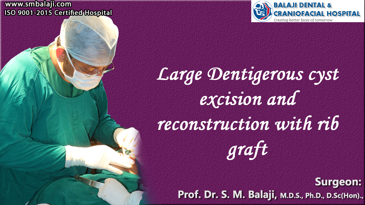 Large Dentigerous cyst excision and reconstruction with rib graft