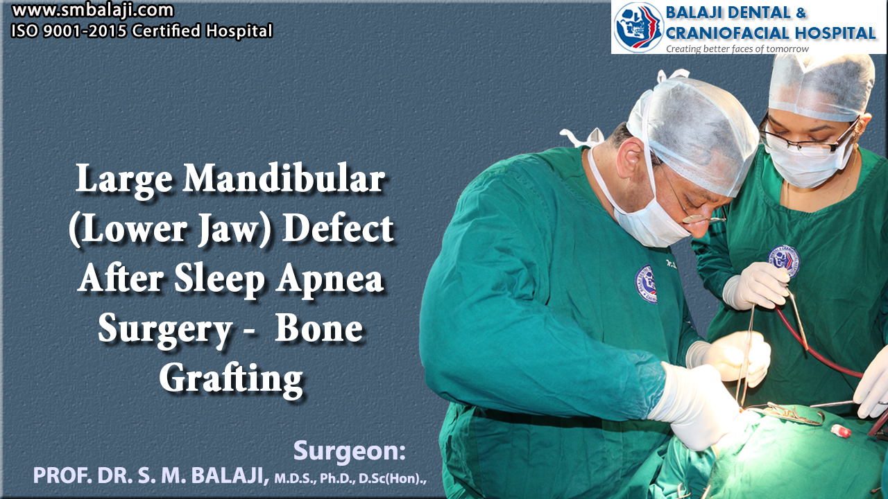 Large mandibular defect (Lower jaw) after sleep apnea surgery - Bone grafting