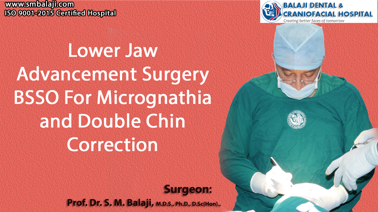 Lower Jaw Advancement Surgery BSSO For Micrognathia and Double Chin Correction
