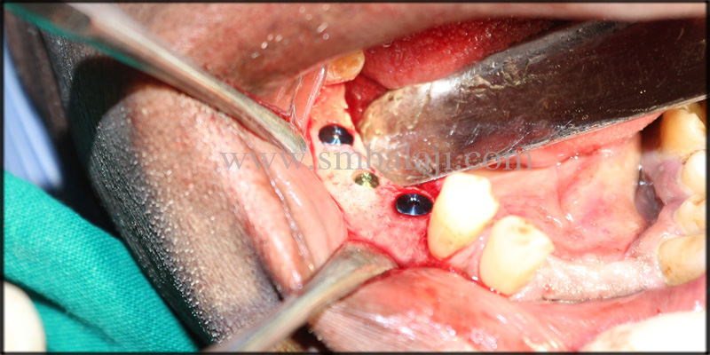 Dental Implants Placed In Lower Right Posterior Region