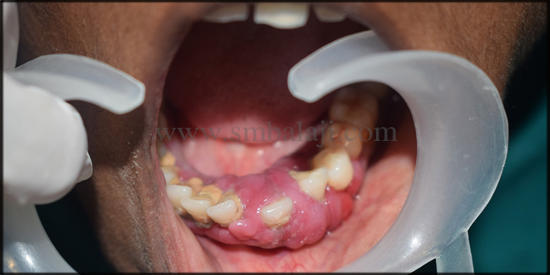 Patient With Severe Tartar And Swollen Gums Leading To Periodontally Compromised Teeth