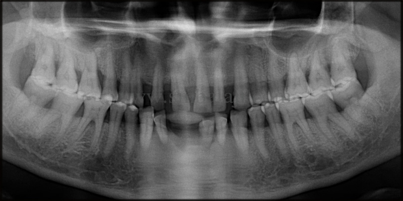 Pre-Operative X-Ray Shows Generalised Bone Loss And Spacing Between Teeth In Upper And Lower Jaw