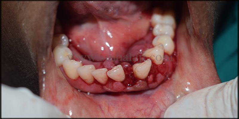 Gingivectomy Done To Recontour The Enlarged Gums In The Lower Front Region
