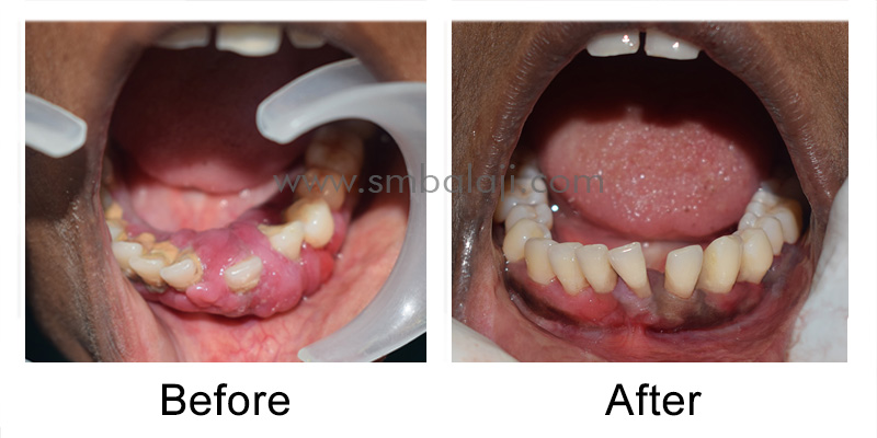 Patient before and after healing of the gum tissues
