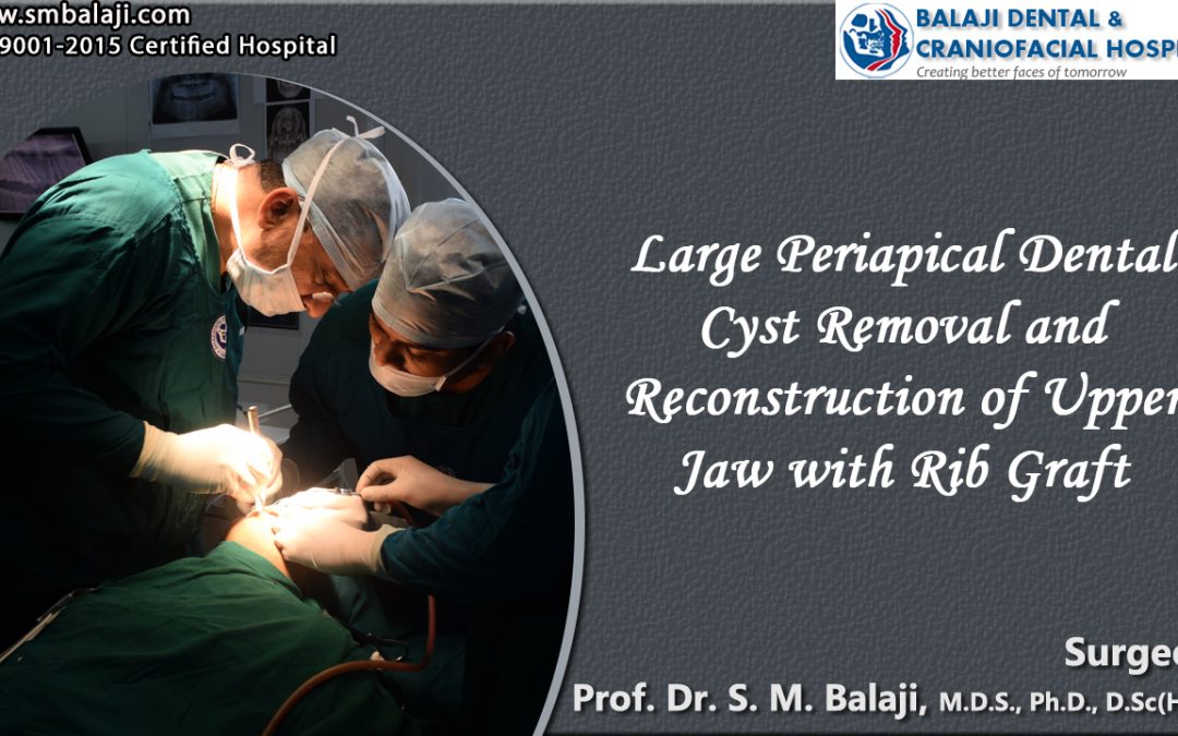 Large Periapical Dental Cyst Removal and Reconstruction of Upper Jaw with Rib Graft