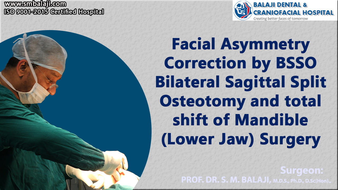 Facial Asymmetry Correction by BSSO Bilateral Sagittal Split Osteotomy and total shift of Mandible (Lower Jaw) Surgery