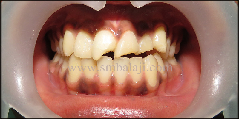 Fixed Zirconia Bridge for Broken Teeth 1 Patient With Broken Upper Front Teeth