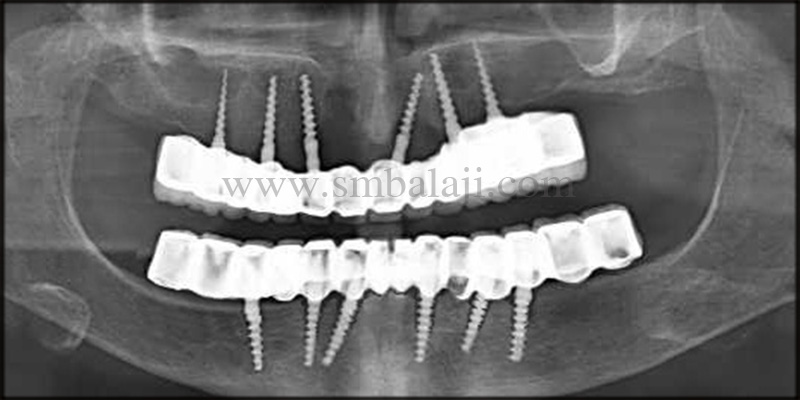 Pre-Operative X-Ray Taken Shows Diffuse Radiolucency Around The Implants In The Upper And Lower Arch Indicating Severe Bone Loss