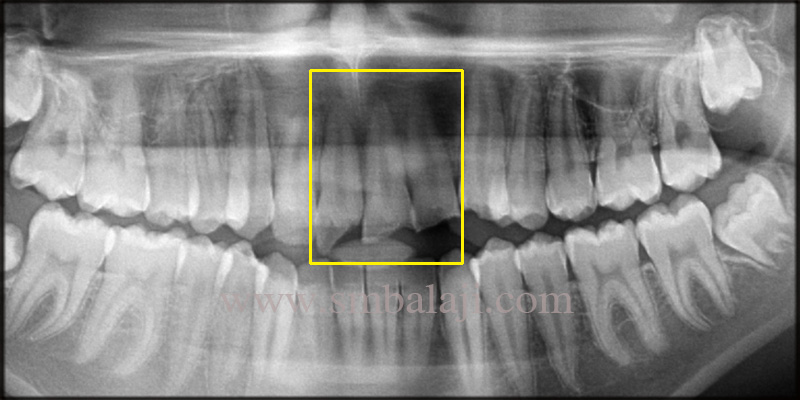 Pre-Operative Opg Taken Shows Cracked Upper Anterior Teeth, Exposing The Underlying Structure