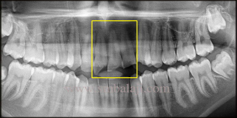 Fixed Zirconia Bridge for Broken Teeth 2 Pre-Operative Opg Taken Shows Cracked Upper Anterior Teeth, Exposing The Underlying Structure