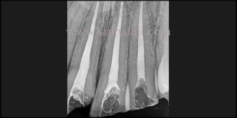 X-Ray Shows Successful Root Canal Treatment Done For The Relative Teeth