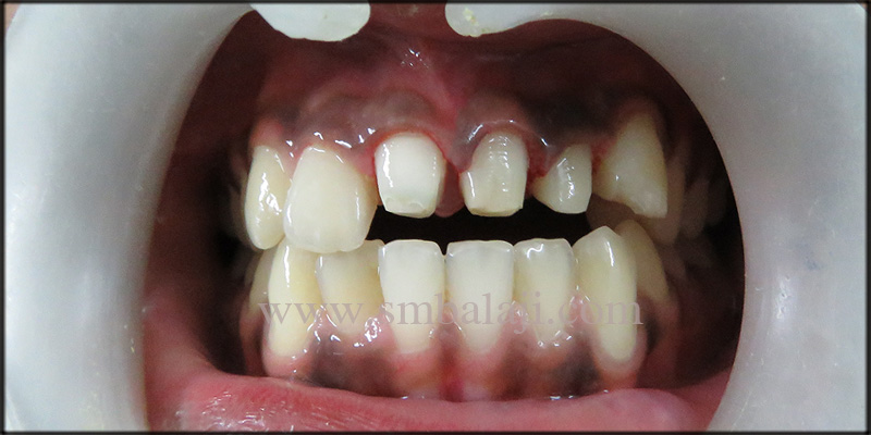 Fixed Zirconia Bridge for Broken Teeth 4 Crown Preparation Done For Bridge Fixation