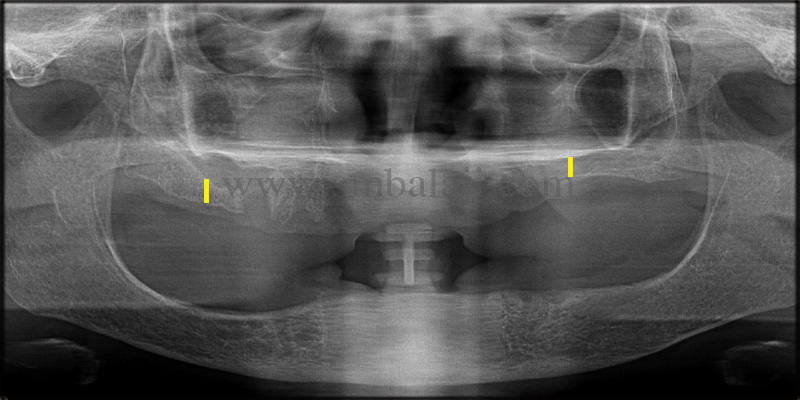 Opg Taken Shows Insufficient Bone Height In The Upper Posterior Region