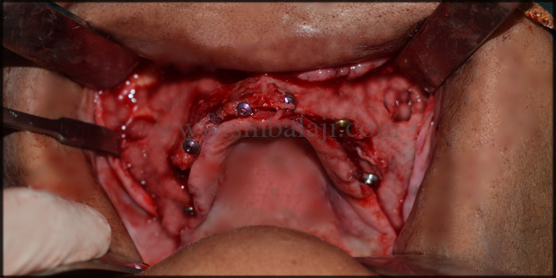 Patient After Healing Of The Gum Tissues
