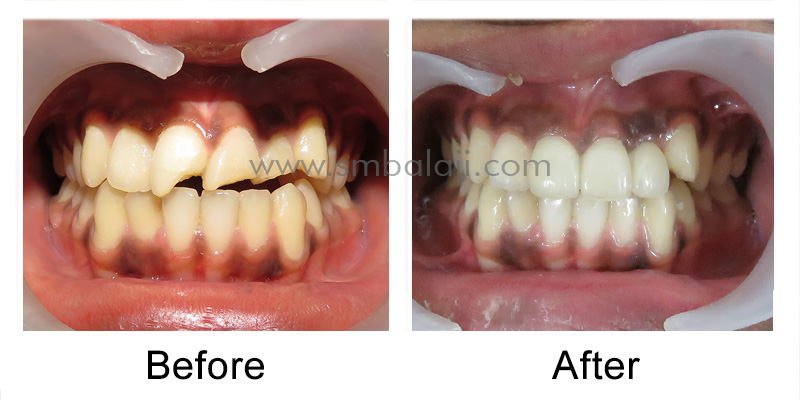 Fixed Zirconia Bridge for Broken Teeth 6 Patient Before And After Changeover