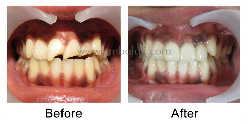 Patient before and after changeover