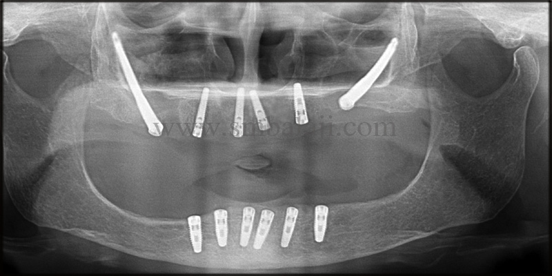 Post-Operative Opg Shows Well Osseointegrated Dental Implants With The Jaw Bone