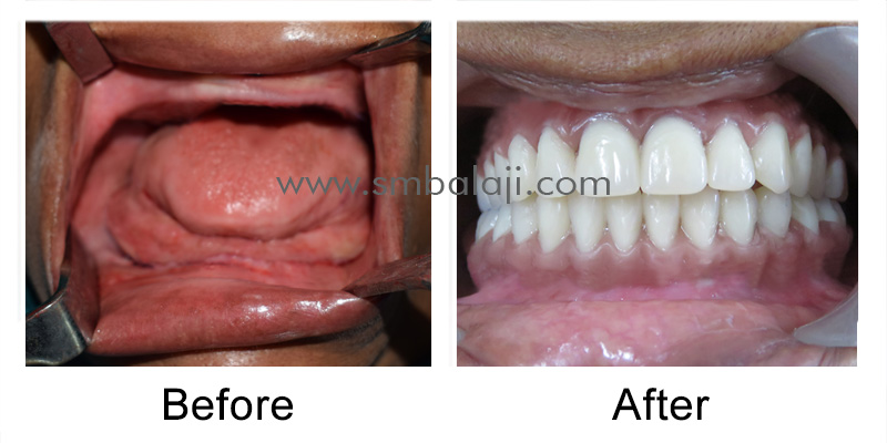 Zygoma implants for Atrophic upper jaw 8 Patient Before And After Makeover