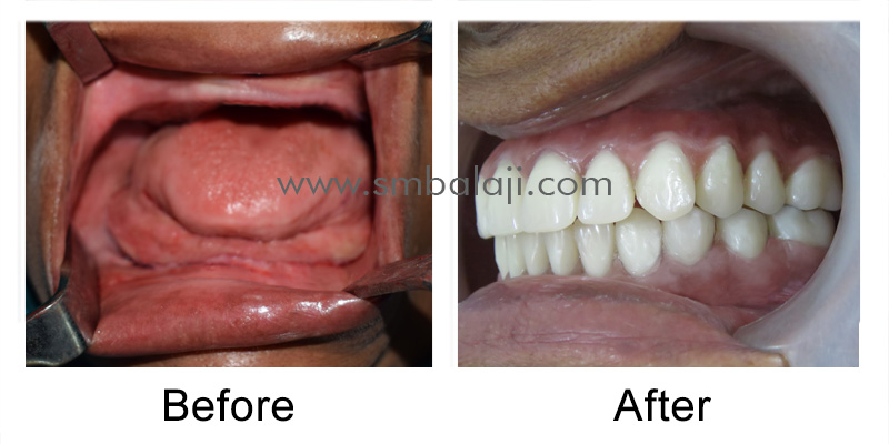 Zygoma Implant Patient before and after