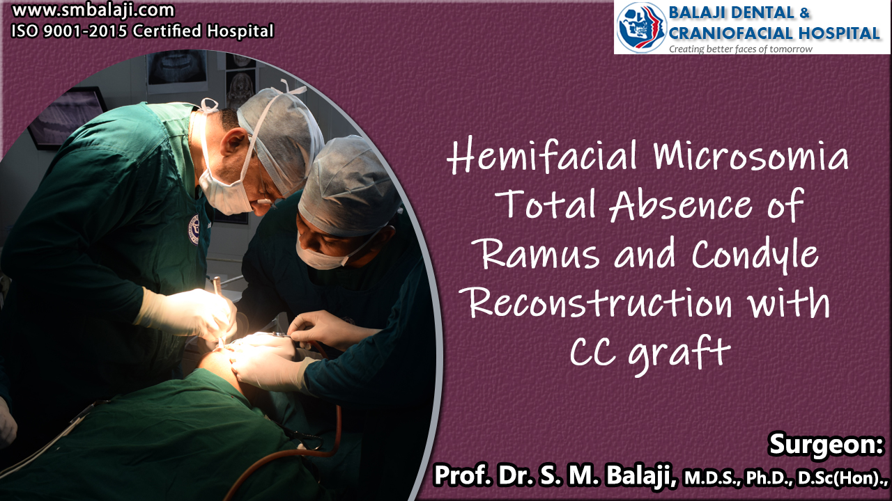 Hemifacial Microsomia total Absence of Ramus and Condyle Reconstruction with costochondral graft