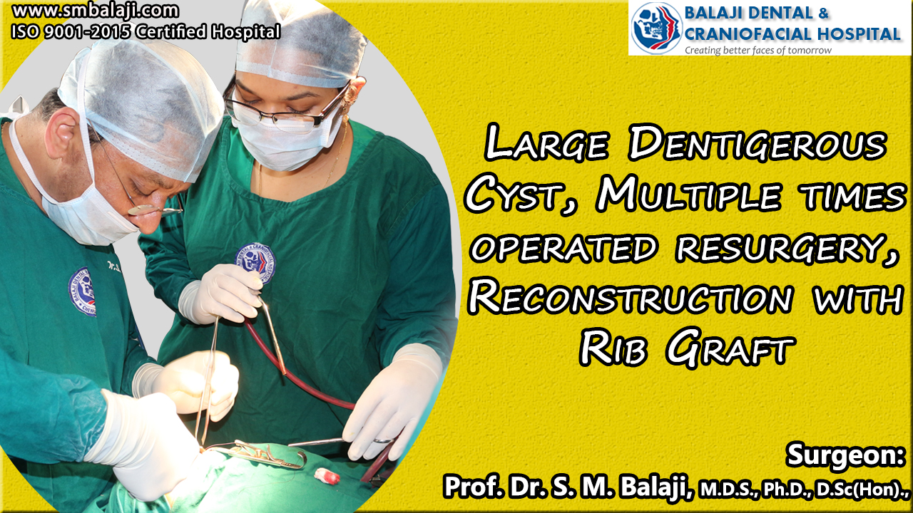 Large Dentigerous Cyst, Multiple times operated Resurgery, Reconstruction with Rib Graft