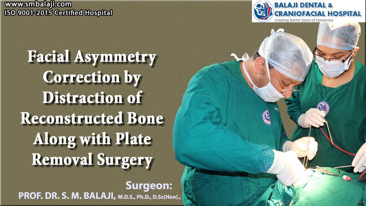 Facial Asymmetry Correction by distraction of reconstructed bone along with Plate removal Surgery
