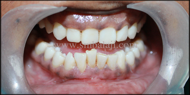 1) Patient With Malaligned Lower Front Teeth